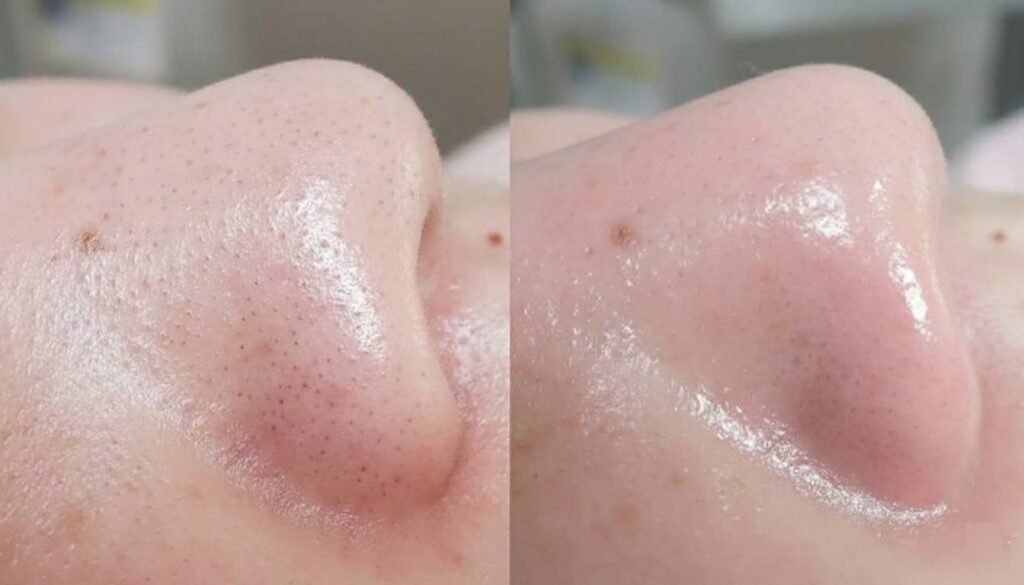 블랙헤드 없애는법 전후 사진
