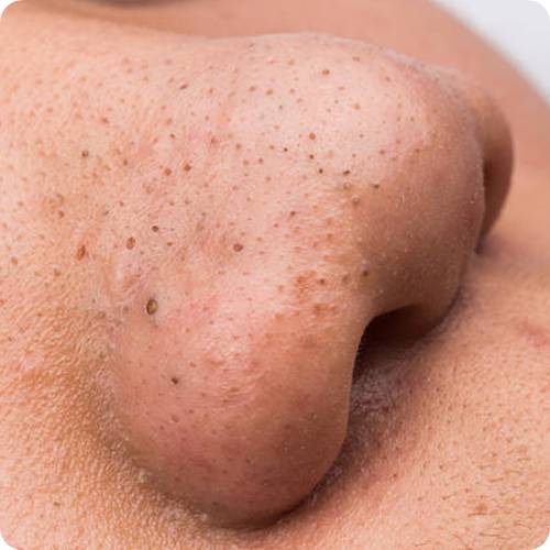 블렉헤드