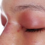 눈가와 이마 주변이 붓고 부은 모습으로, 얼굴 붓기의 원인과 관리 필요성을 보여주는 이미지 A close-up view of facial swelling around the eyes, illustrating the causes and need for managing puffiness