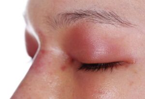 아침마다 붓는 걱정한다면, 붓기 빼는 음식 8가지 필독!