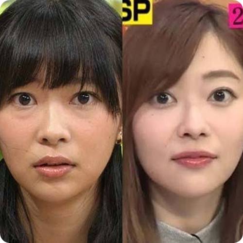 눈밑 지방 제거 방법