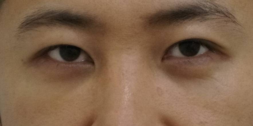 남성의 다크서클