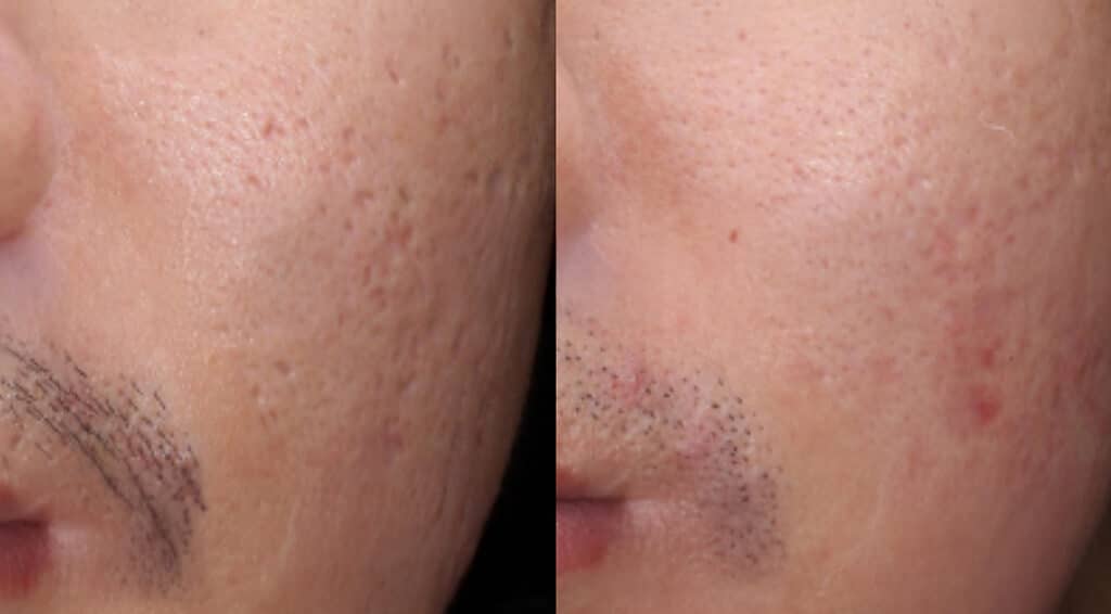 여드름 흉터 관리 전후의 비교 사진으로, 시술이나 피부 치료 후 피부결이 개선된 모습을 나타낸 이미지 Before and after comparison of acne scar treatment showing smoother skin texture after care