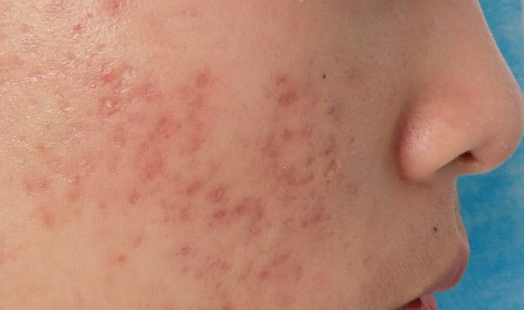 볼 주변에 붉은 여드름 자국과 흉터가 남은 피부 클로즈업으로, 여드름 흉터 관리가 필요한 피부 상태를 보여주는 이미지 A close-up of facial skin with red acne scars, showing a skin condition that requires acne scar treatment